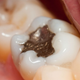 Illustration for article titled In 2003, half the mercury in U.S. wastewater came from your dentist